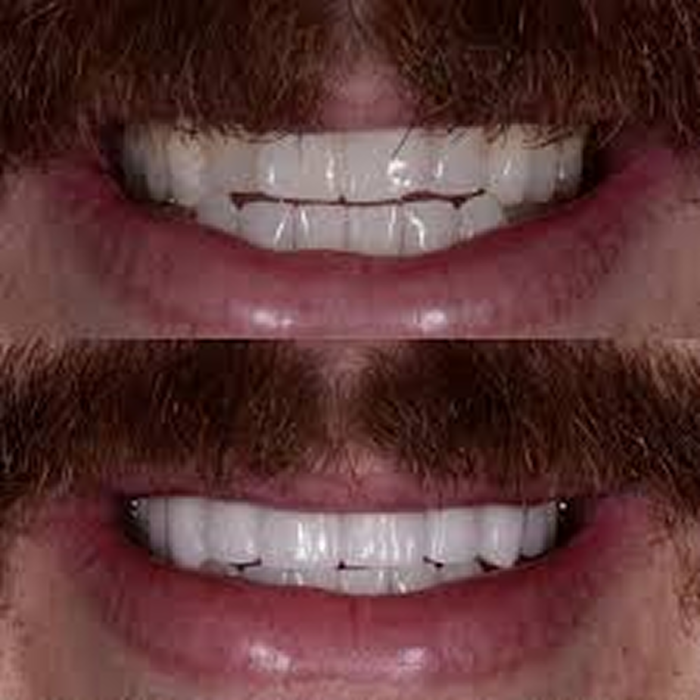 Two images showing teeth before and after dental treatment.