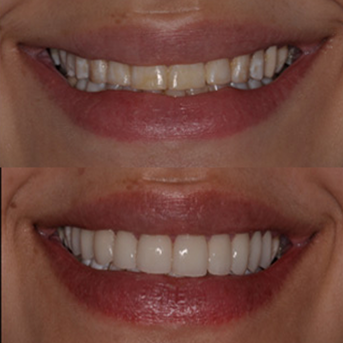 Before and after images of a person's smile with teeth whitening.