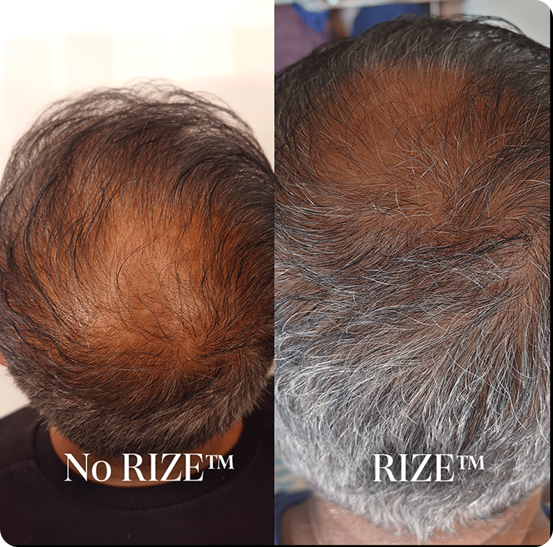 Before and after scalp treatment comparison showing skin improvement.