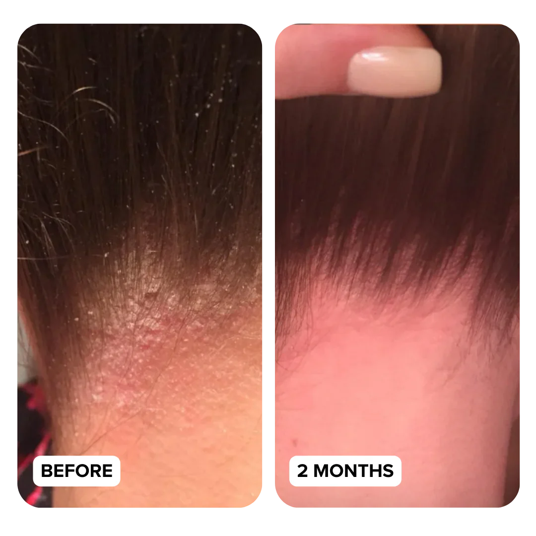 Side-by-side comparison of scalp before and after two months.