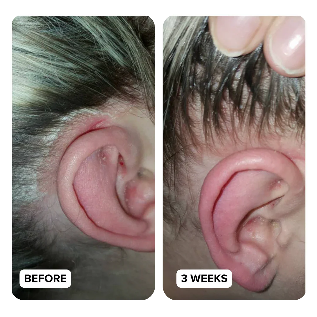 Two close-up images of an ear, labeled 'Before' and '3 Weeks.'