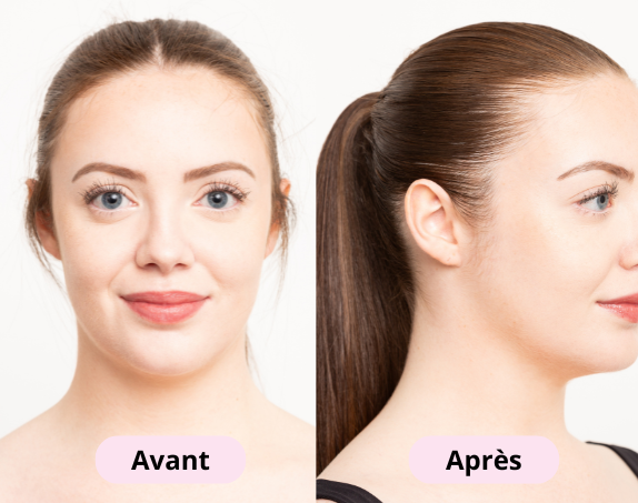 Side-by-side comparison of a woman's face labeled 'Avant' and 'Après.'