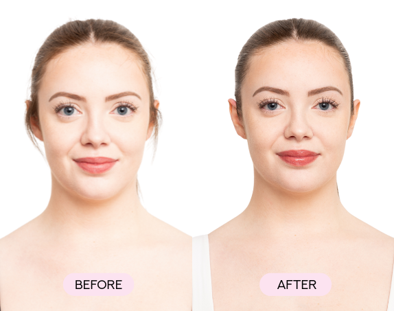 Side-by-side comparison of a woman's face labeled 'Before' and 'After.'