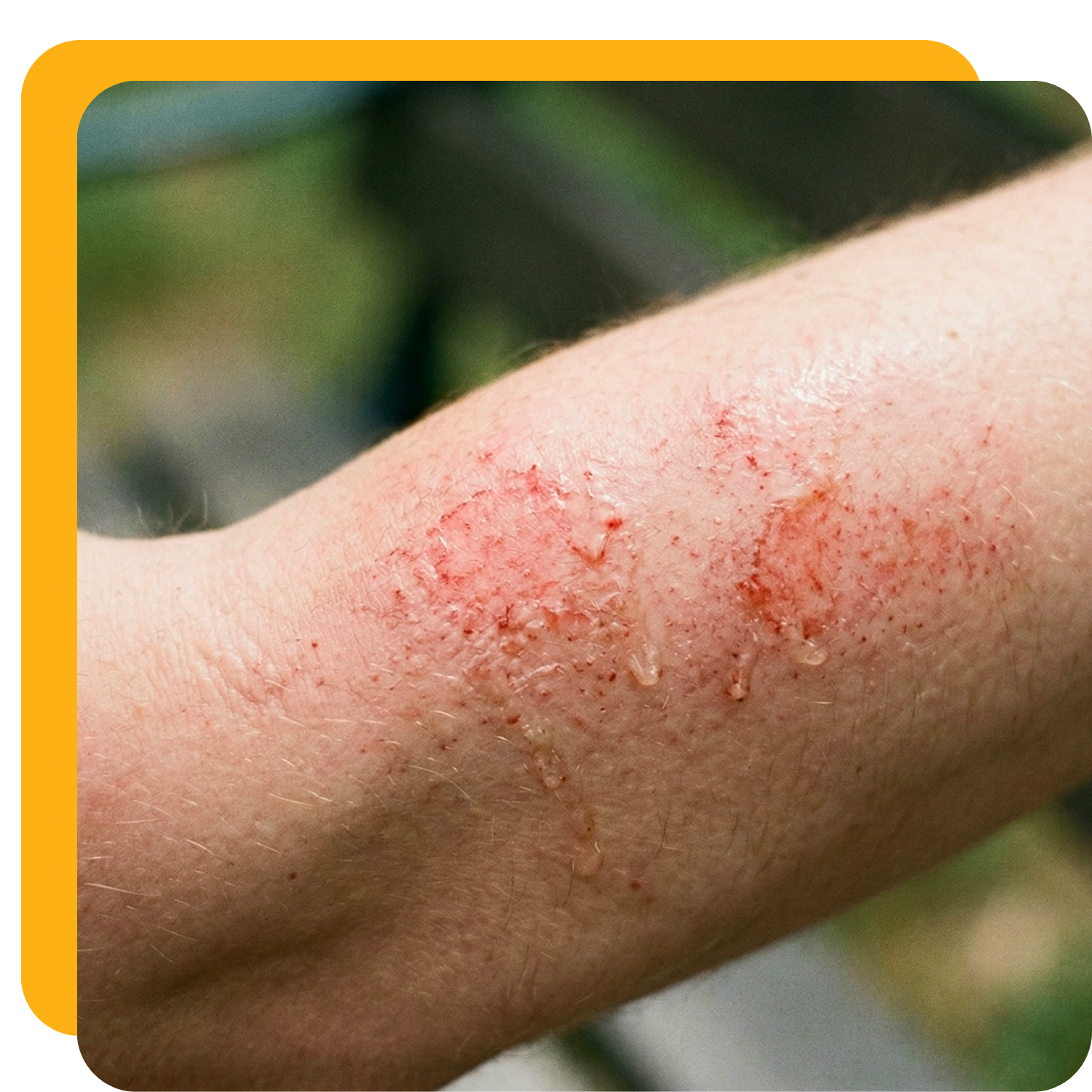 A close-up of a red, raw scrape on a person's forearm with a clear ointment applied.