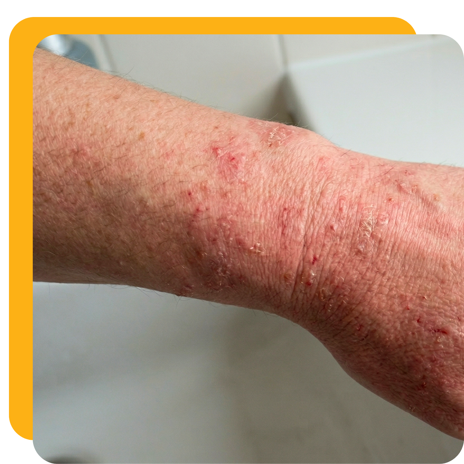 A close-up of a person's forearm and wrist with red, dry, and scaly skin.