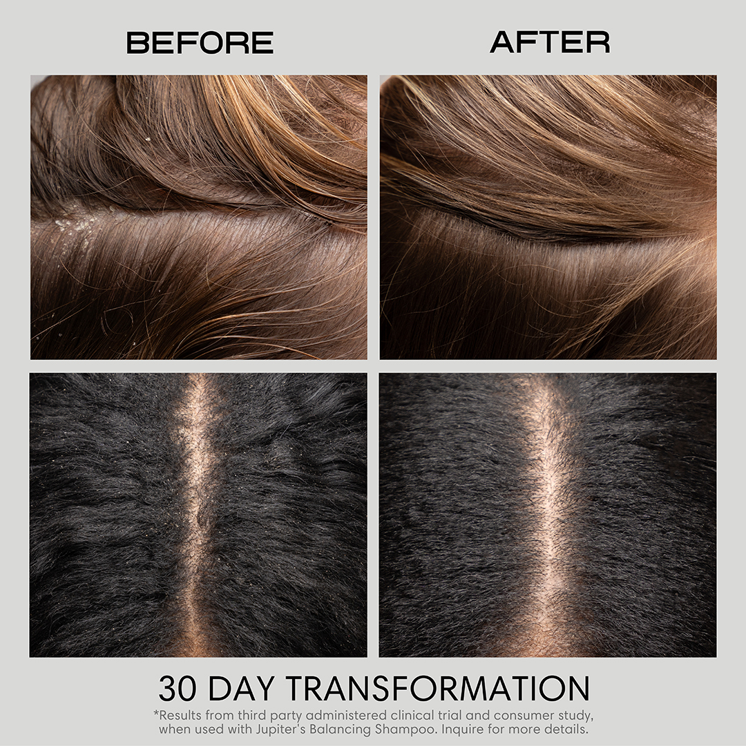 Before and after scalp transformation images after 30 days of shampoo use.