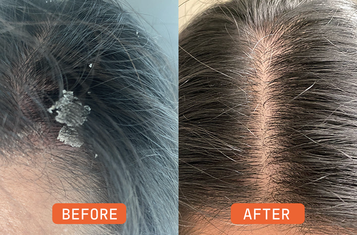 A before and after image showing a scalp with dandruff on the left and a clean scalp on the right.