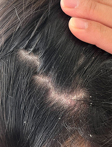 Close-up of scalp with visible dandruff and fingers parting black hair.