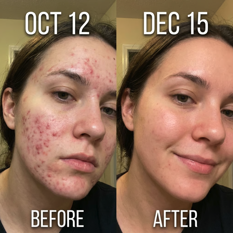 A before and after comparison of a woman's face, showing a significant reduction in acne over two months.