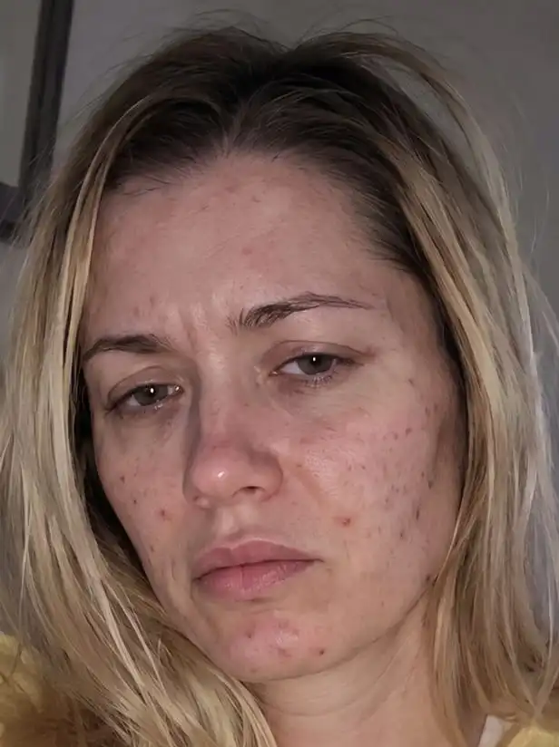 A close-up of a woman's face showing acne and blemishes, with a tired or distressed expression.