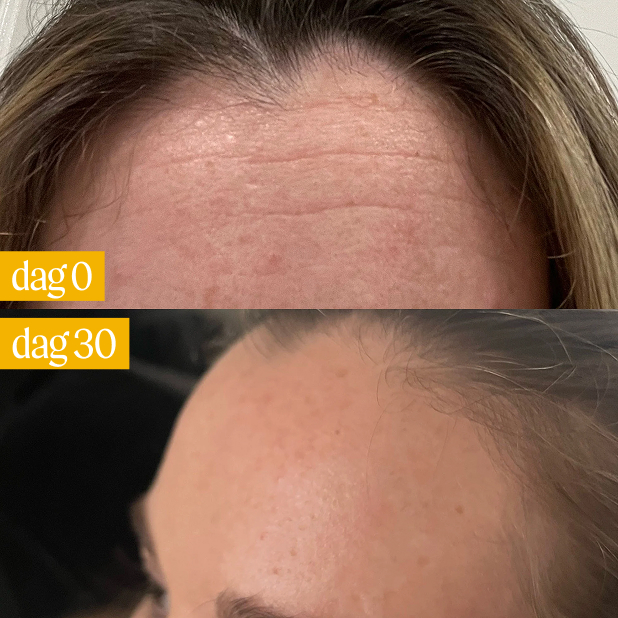 Before and after forehead close-up with 'dag 0' and 'dag 30' labels.