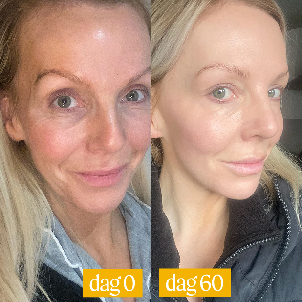 Side-by-side photos of a woman's face labeled dag 0 and dag 60.