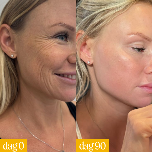 Side-by-side comparison of a woman's face on day 0 and day 90.