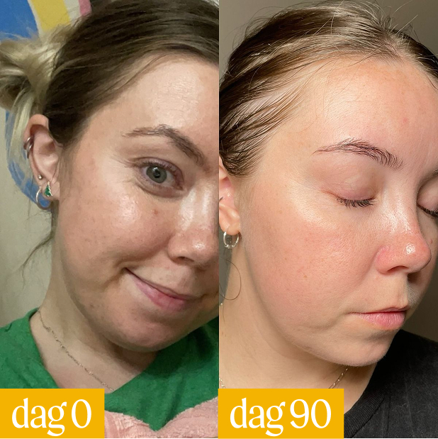 Side-by-side comparison of a woman's face on day 0 and day 90.