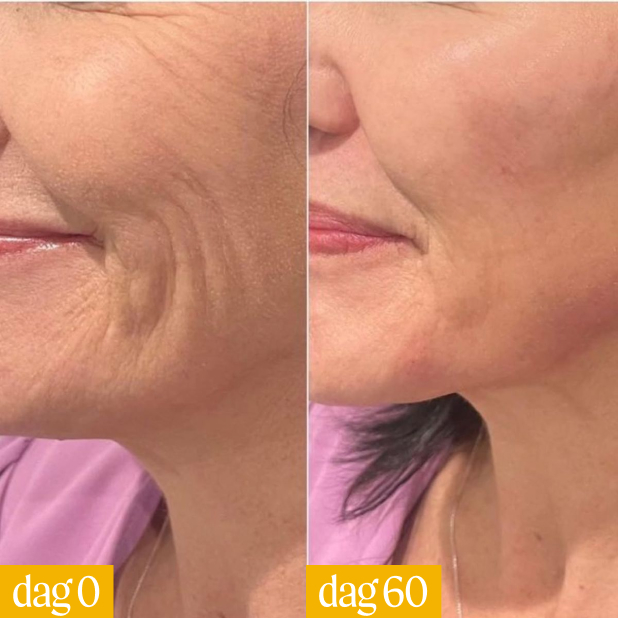 Side-by-side comparison of facial skin before and after improvement over 60 days.
