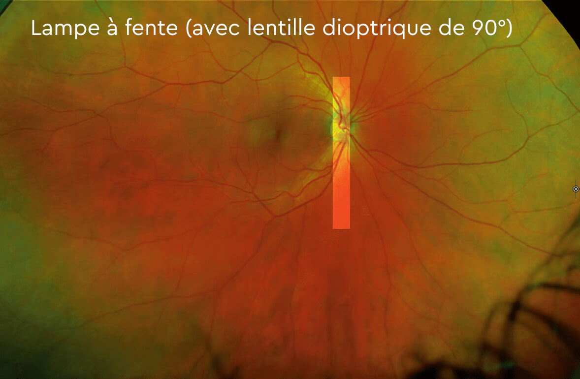 Lampe à fente