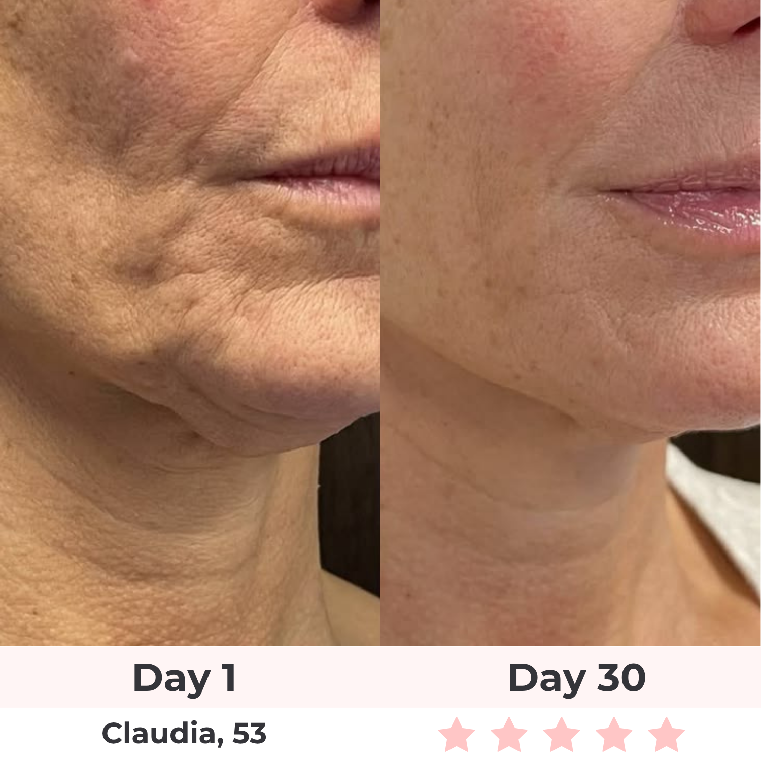 A before and after comparison of a woman's lower face showing a reduction in wrinkles over 30 days.