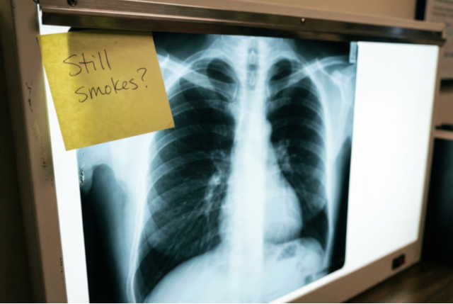 Chest X-ray on lightbox with yellow sticky note reading 'Still smokes?'