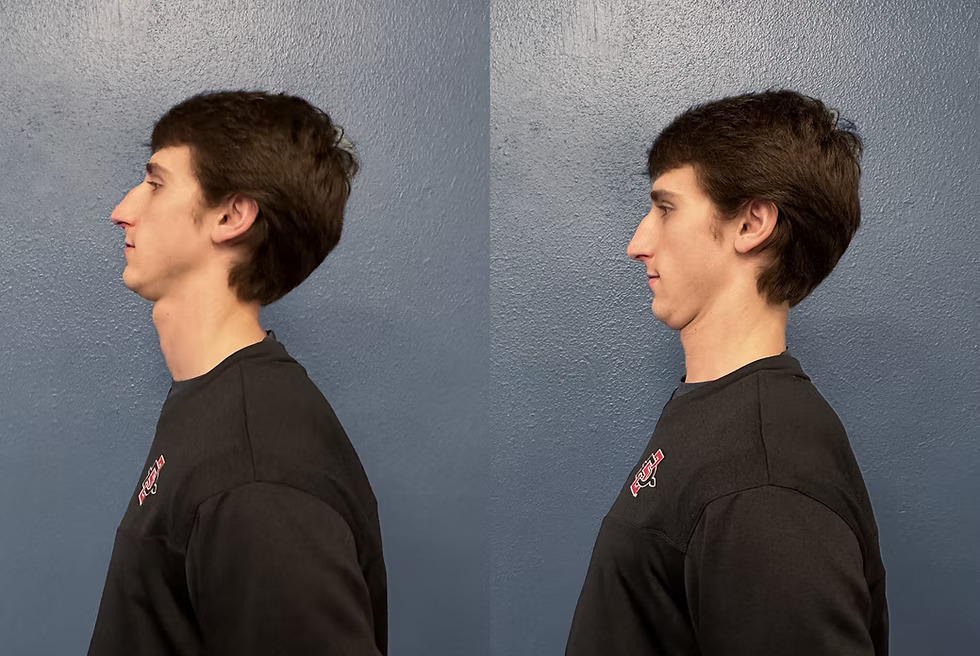 A before and after, side-profile view of a young man showing a correction in his posture.
