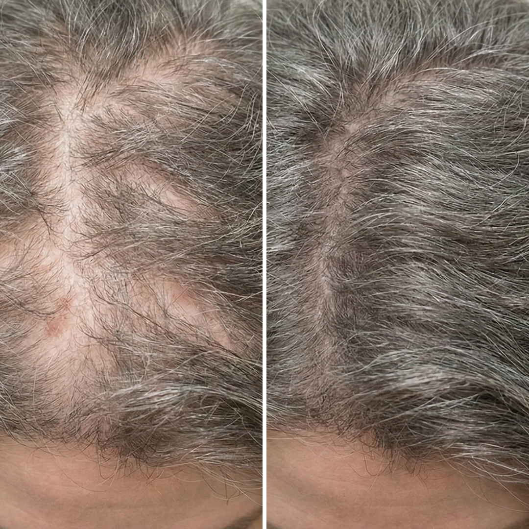 A side-by-side comparison of a scalp with thinning gray hair, then with thicker, fuller hair.