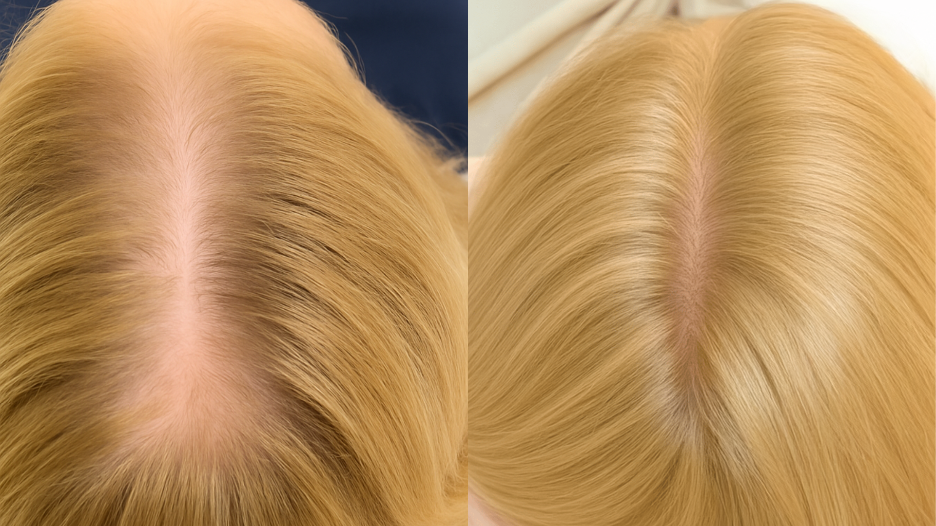 Side-by-side comparison of two scalps with blonde hair, showing different hair densities.