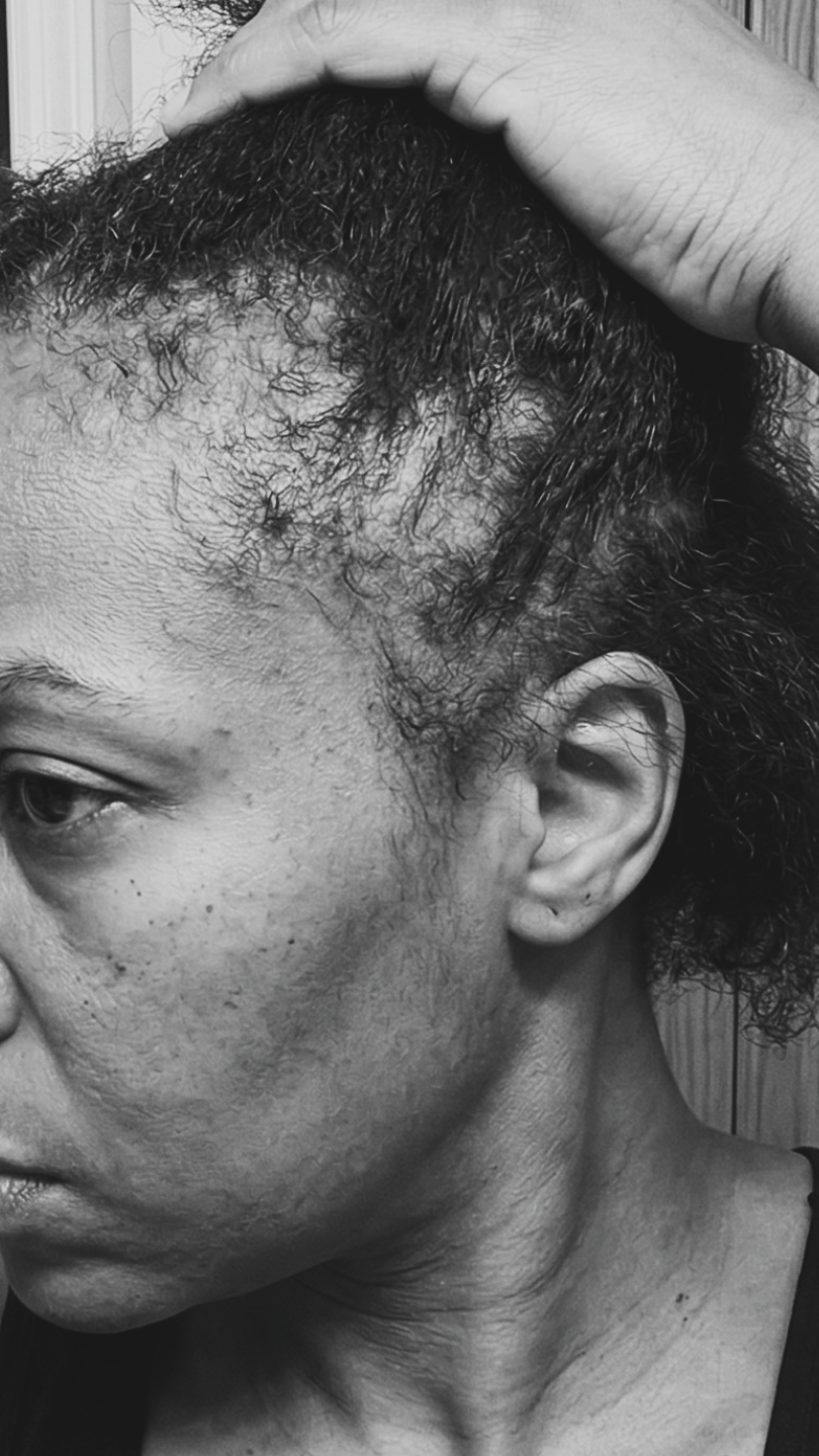A black and white close-up of a person pulling back their hair, showing thinning at the hairline.