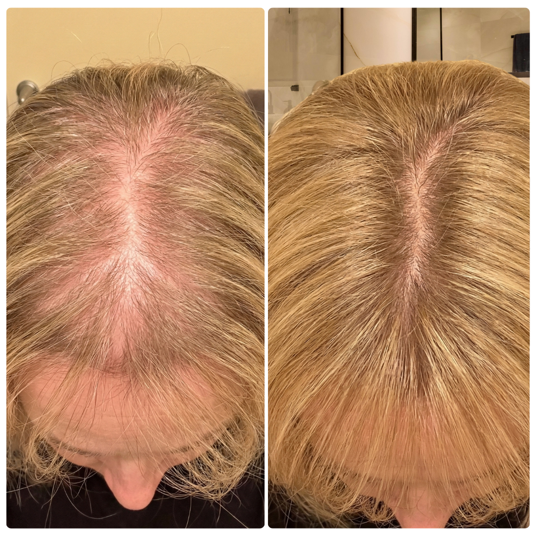 A before-and-after comparison showing the top of a person's head with thinning hair and then with fuller hair.