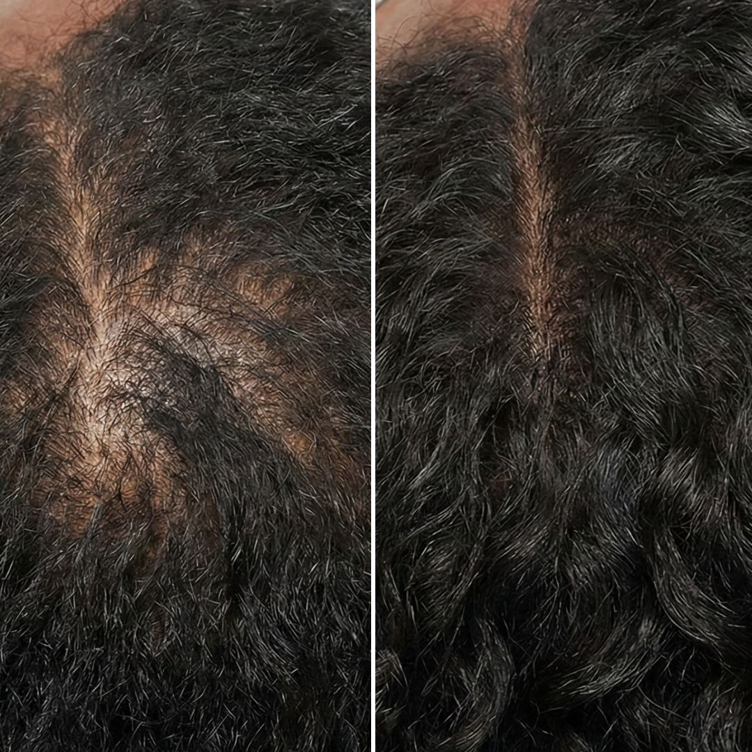 A side-by-side comparison of a person's scalp, showing thinner hair on the left and thicker hair on the right.
