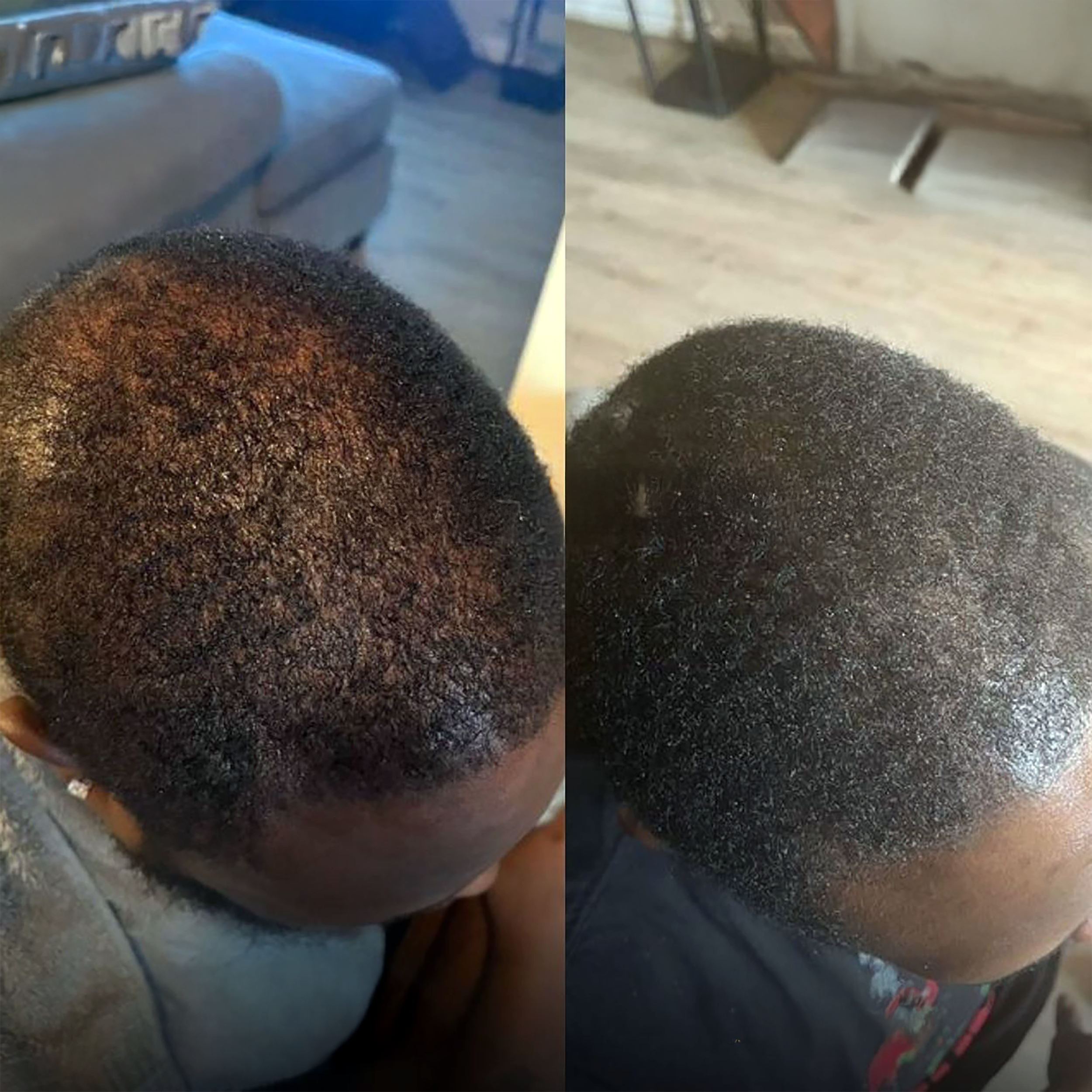 Side-by-side comparison of a person's scalp before and after hair treatment.