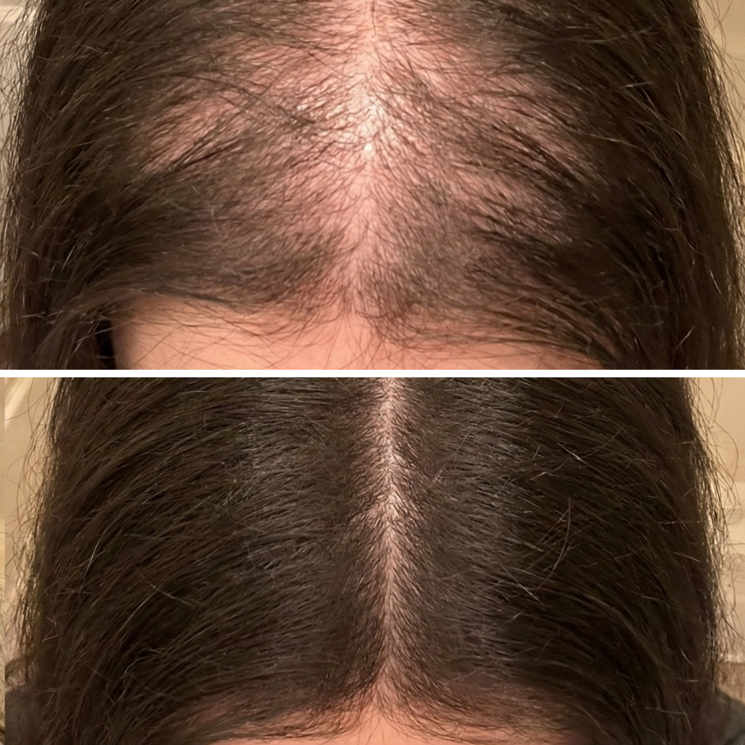 A before and after comparison of hair thinning and regrowth on a person's scalp.