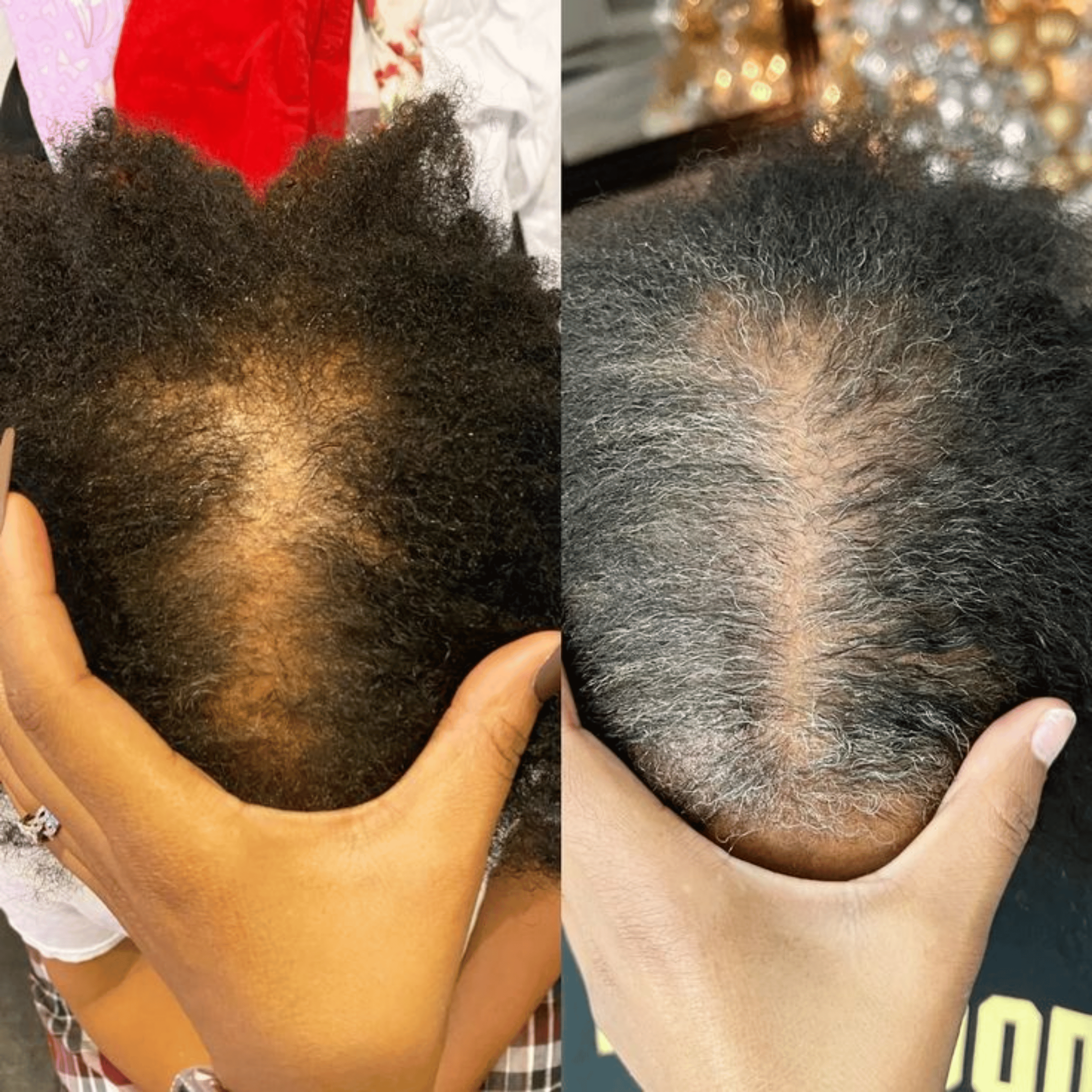 Side-by-side comparison of hair growth on a person's scalp.