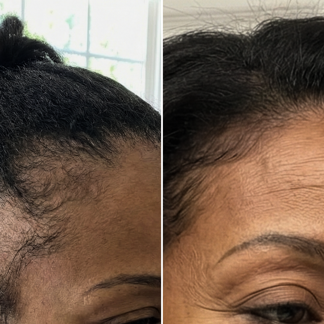 A side-by-side comparison showing a woman's hairline before and after, with visible new hair growth.