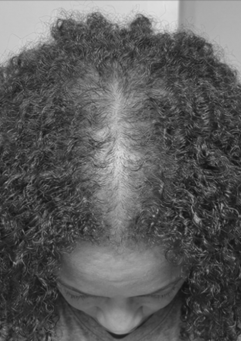 Person with curly hair and visible scalp at the top of the head.