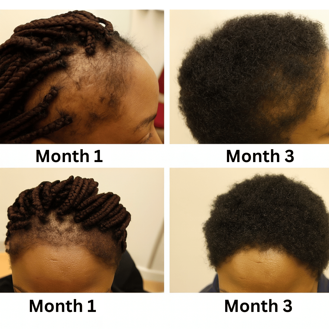 Four images showing hair growth progress from month 1 to month 3.