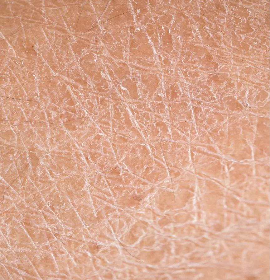 A close-up, macro photograph of dry, cracked human skin with a few fine hairs visible.