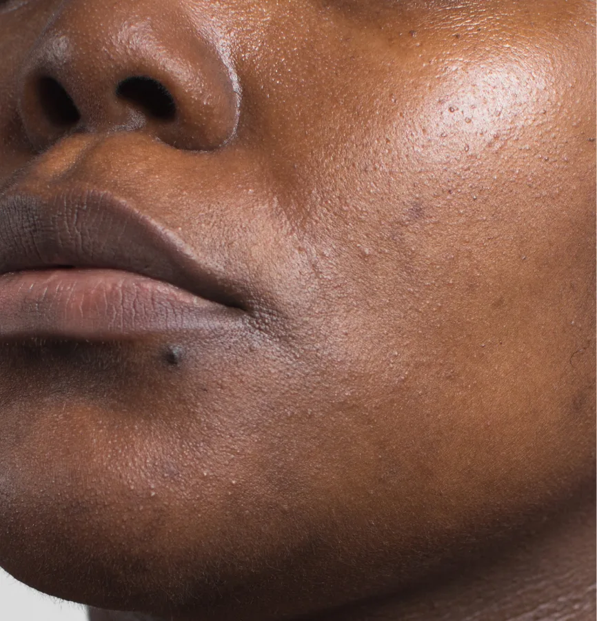 A close-up of a person's face, showing the skin texture on their cheek, nose, and mouth area.