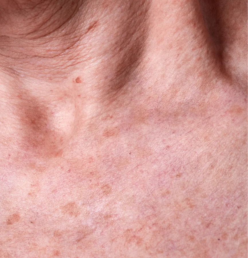 A close-up of an older person's neck and chest showing wrinkled skin, moles, and sunspots.