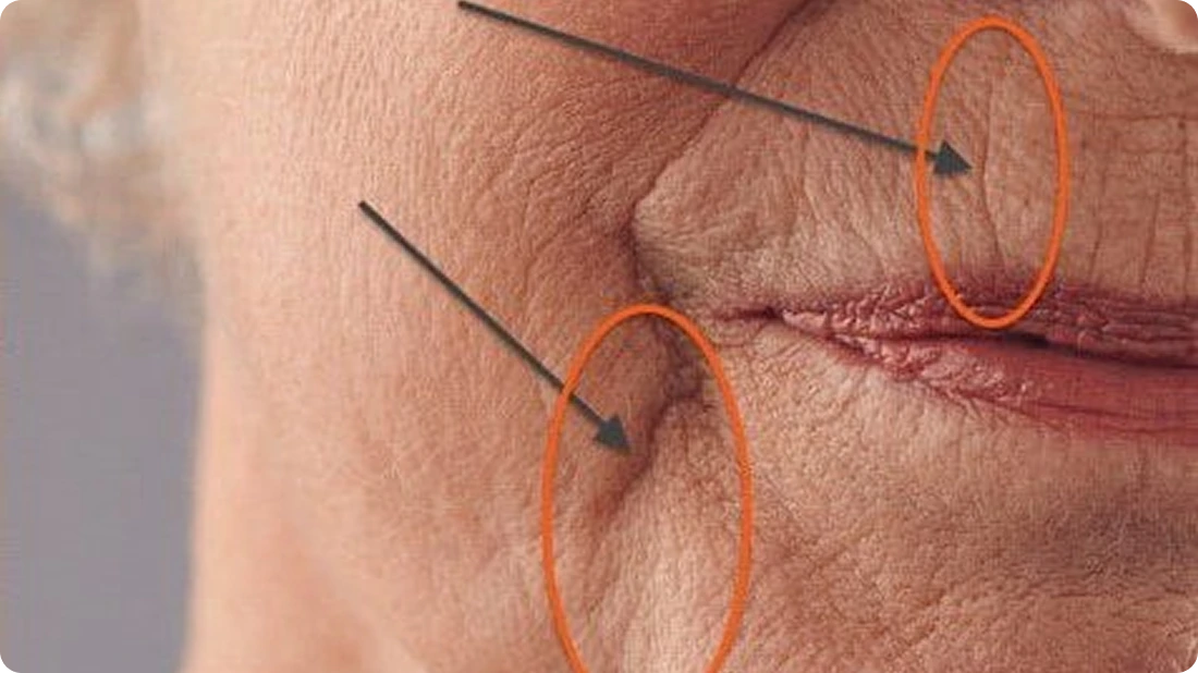 Close-up of wrinkled skin with orange circles and arrows highlighting areas.