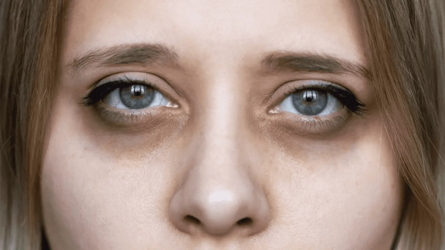 Close-up of a person's eyes with dark circles underneath.