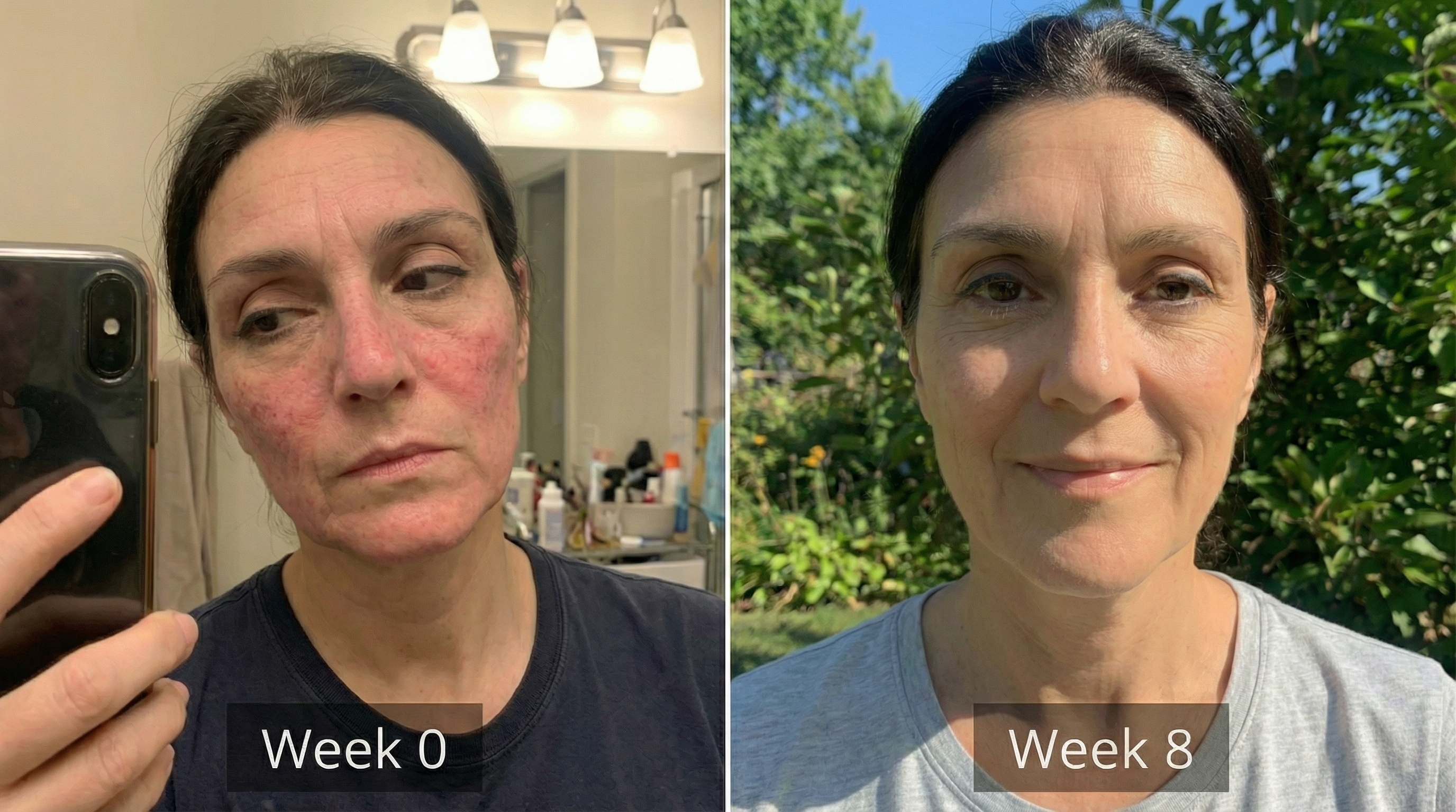 A before and after image showing a woman's facial skin transformation from red and irritated to clear.