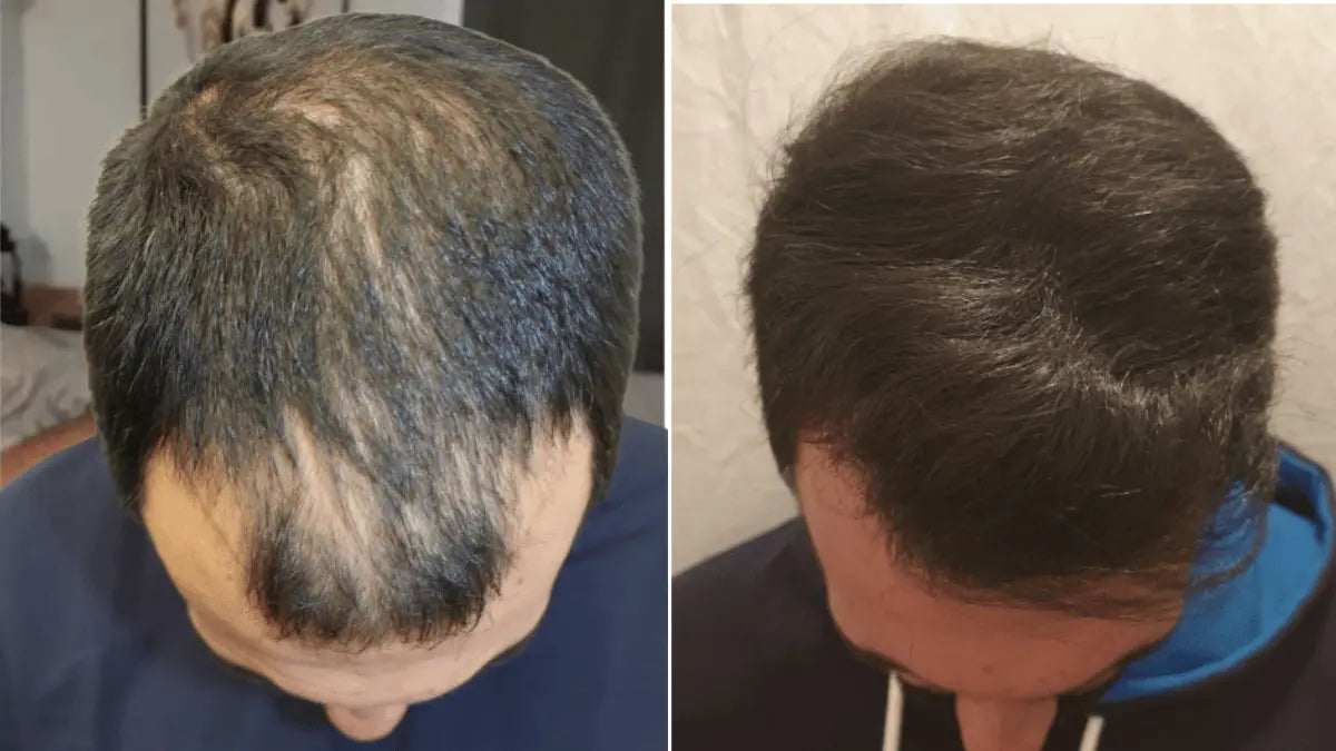 A before and after image showing significant hair regrowth on the top of a man's head.
