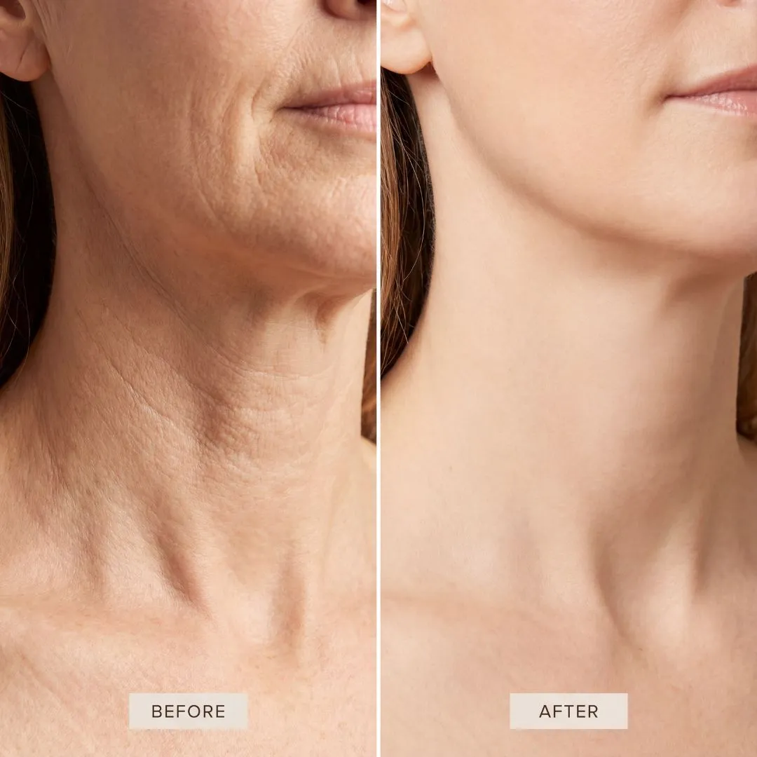 A before and after image showing a woman's face and neck with a visible reduction in wrinkles.