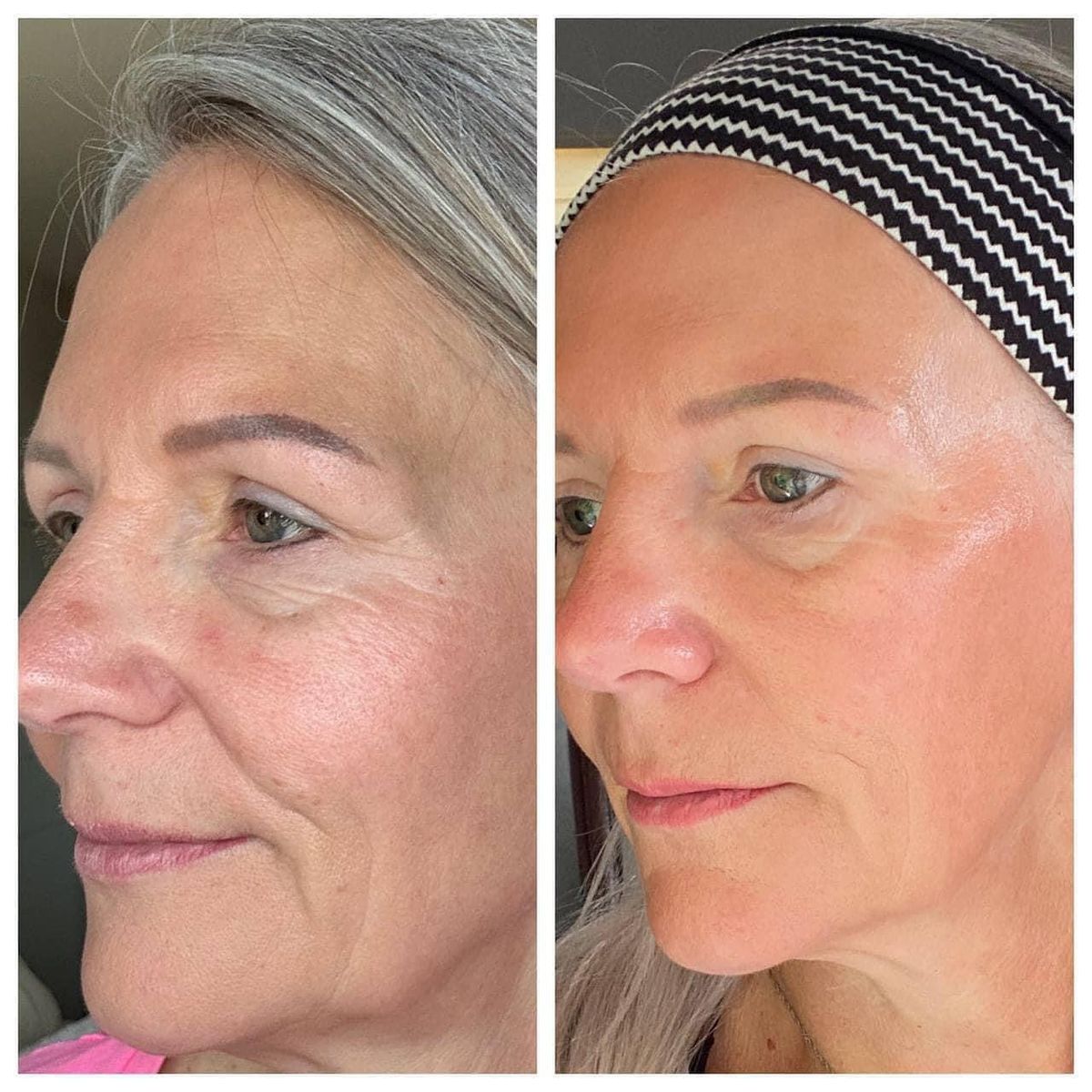 Side-by-side comparison of a woman's face with visible skin differences.