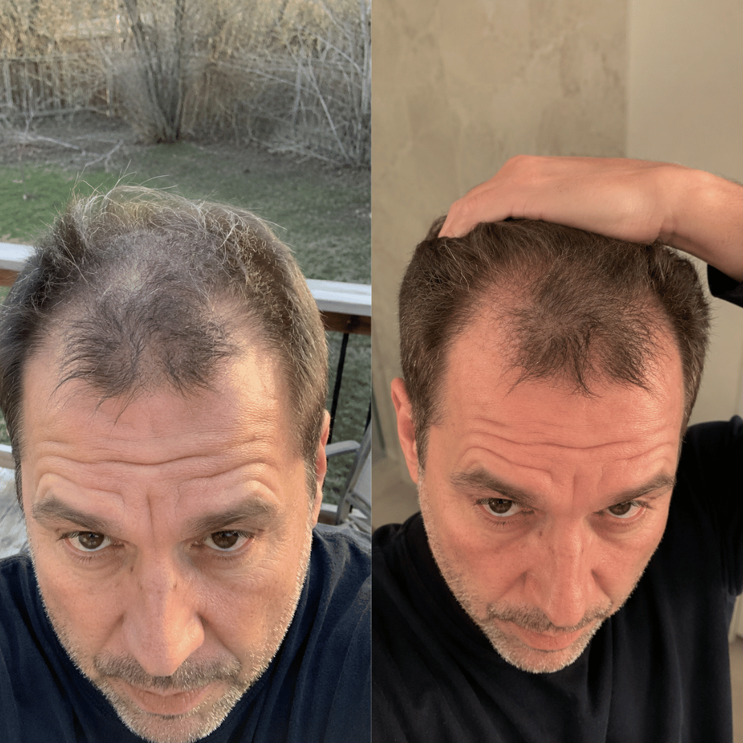 A split-screen image showing a man's scalp from above, with thinner hair on the left and thicker hair on the right.