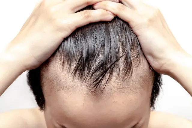 A person's hands push back their thinning, wet hair, revealing a receding hairline against a white background.