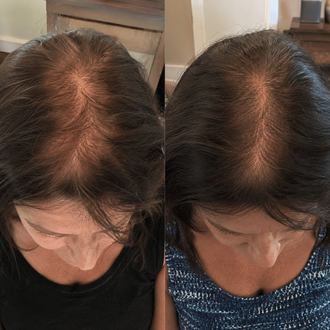 A before-and-after image showing reduced hair thinning on the top of a woman's head.