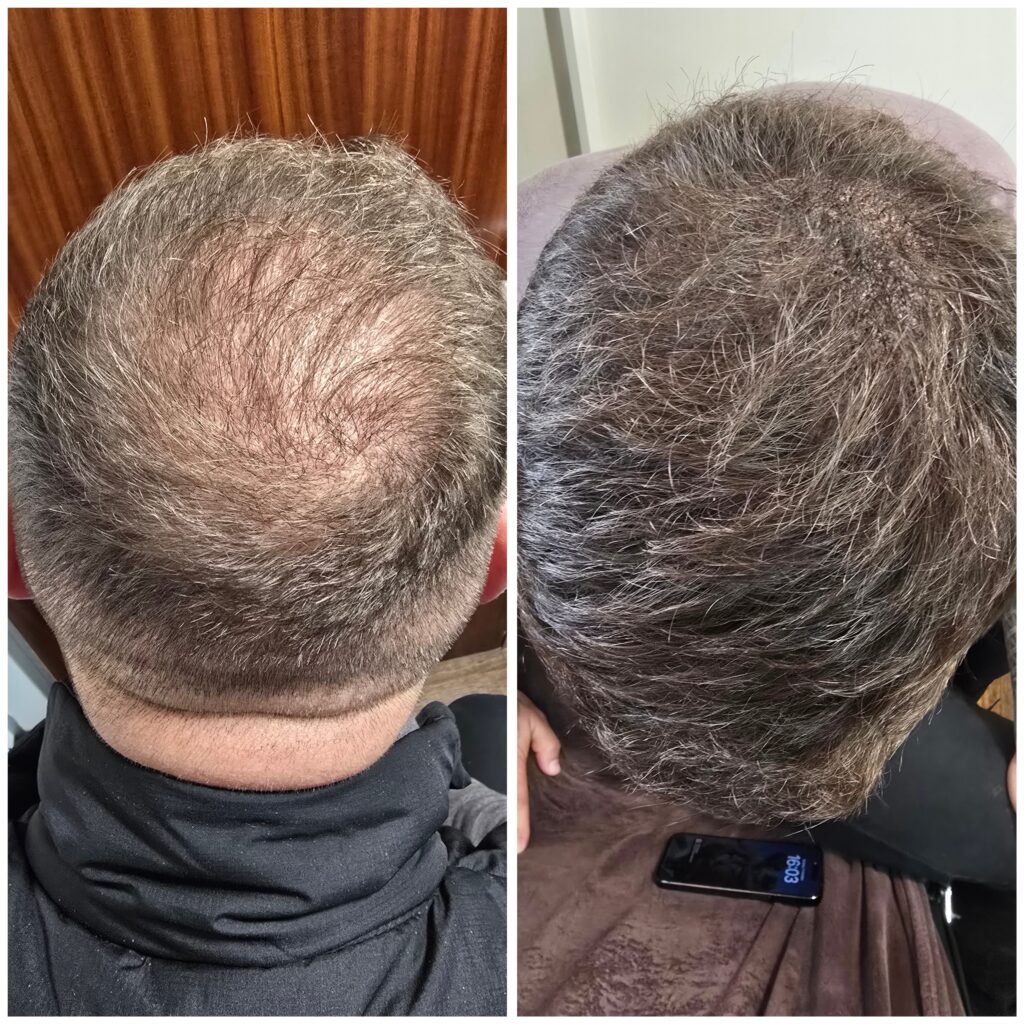 A before-and-after comparison showing hair regrowth on the crown of a man's head.