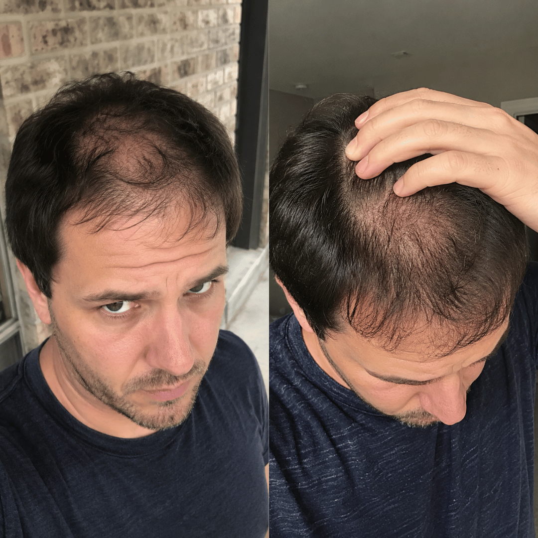 A split image showing two angles of a man with thinning hair on the top of his head.