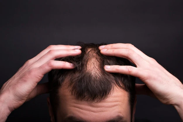 A close-up of a man parting his hair with his hands, showing a thinning scalp.