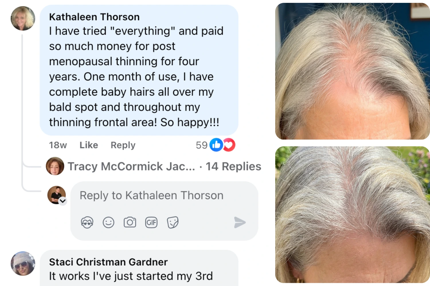 A social media testimonial with before and after photos of a woman's hairline and scalp.